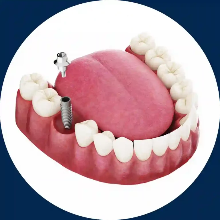 Imagen portada video Implante Unitario DentalVid