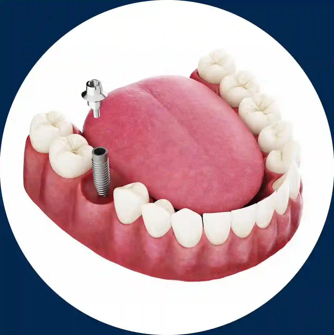 Implante dental unitario | Vídeo 3D DENTALVID
