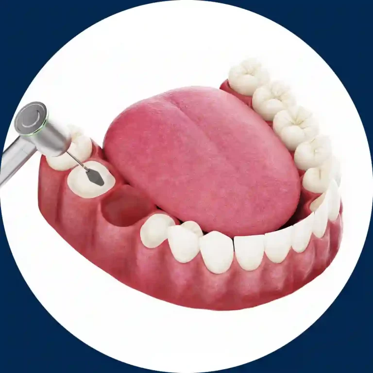 Imagen portada video Puente de 3 piezas DentalVid