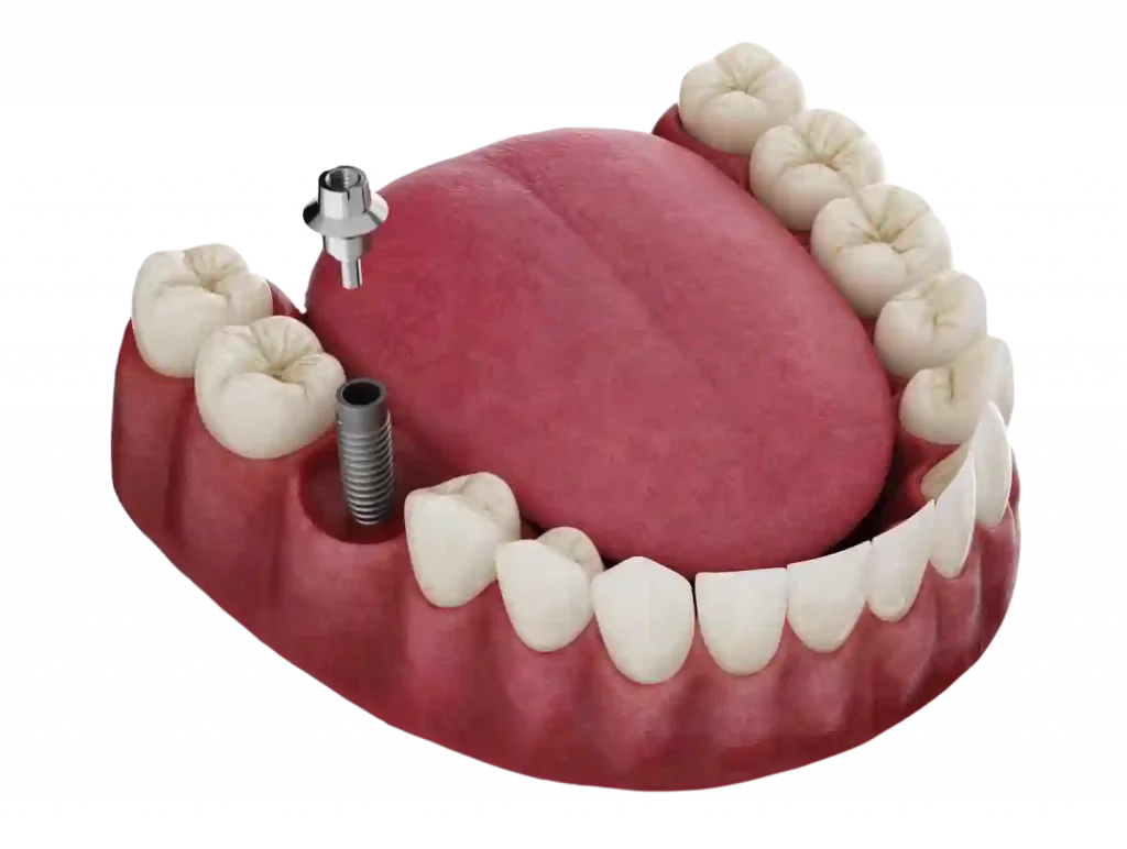 Inicio imagen implante unitario dental web dentalvid fondo transparente